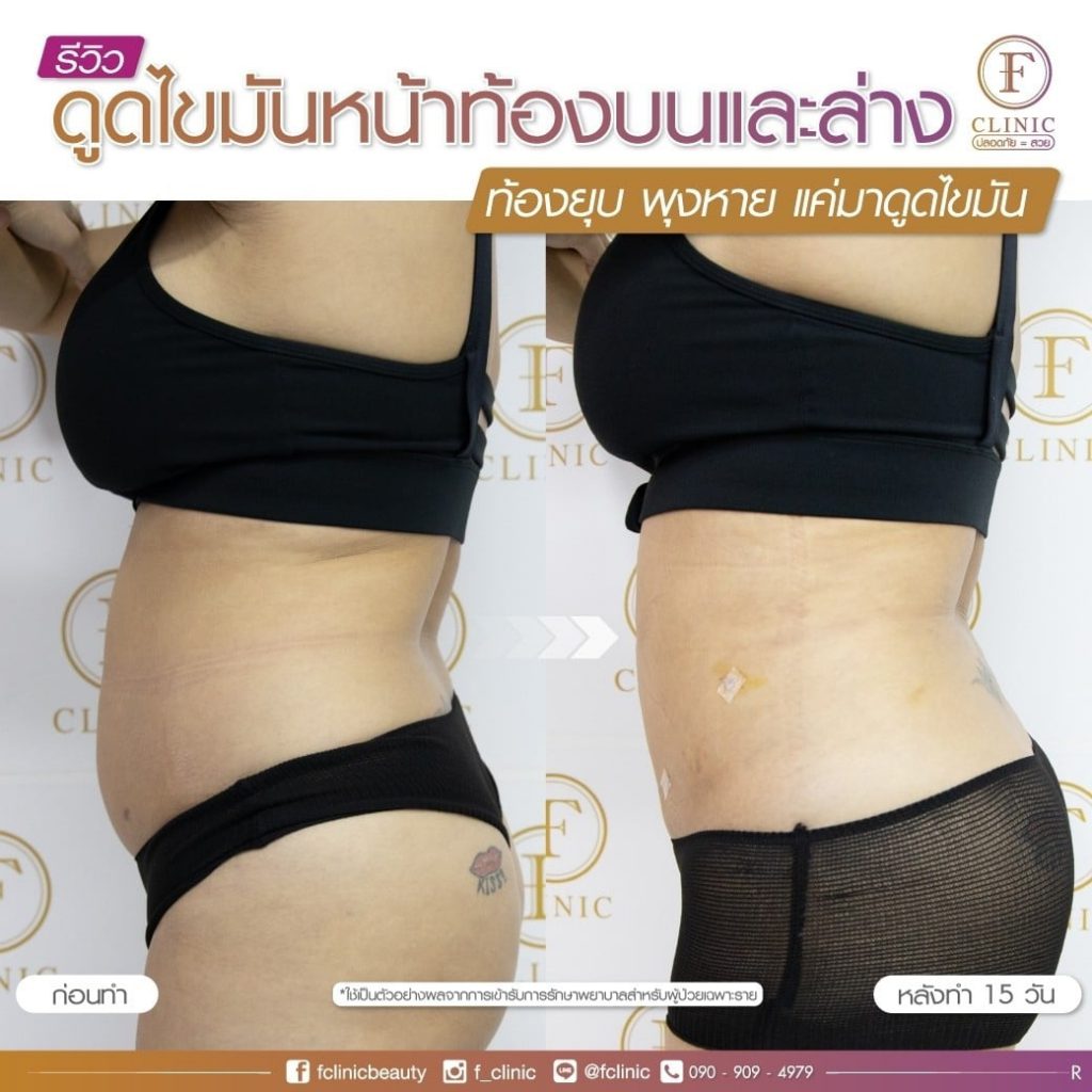 F Clinic คลินิกดูดไขมันเฉพาะส่วน กระชับสัดส่วนทุกจุด หมดปัญหาของคนอยากหุ่นดี - 2