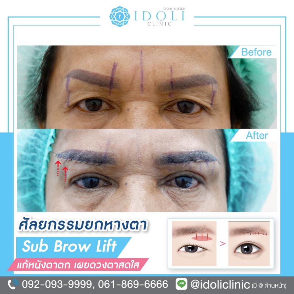 IDOLI Clinic ศัลยกรรมยกคิ้ว เทคนิคสไตล์เกาหลี ไม่ทิ้งรอยแผลเอาไว้ให้กังวล - 2