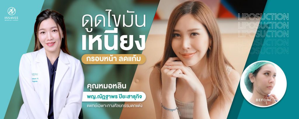 Issavee Clinic ดูดไขมันเหนียง ปรับหน้าเรียว ลดไขมันส่วนเกินบนใบหน้า - 1