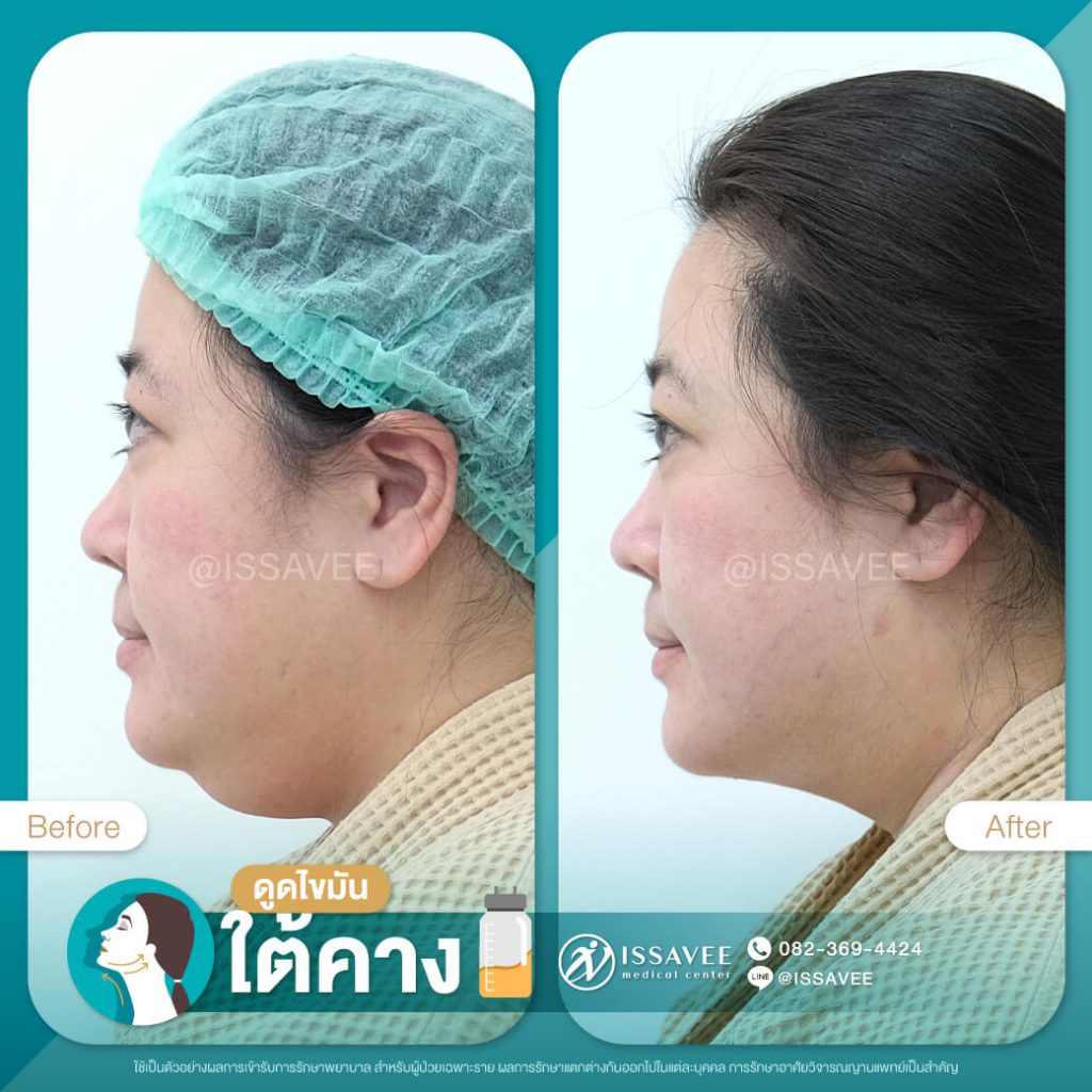 Issavee Clinic ดูดไขมันเหนียง ปรับหน้าเรียว ลดไขมันส่วนเกินบนใบหน้า - 2