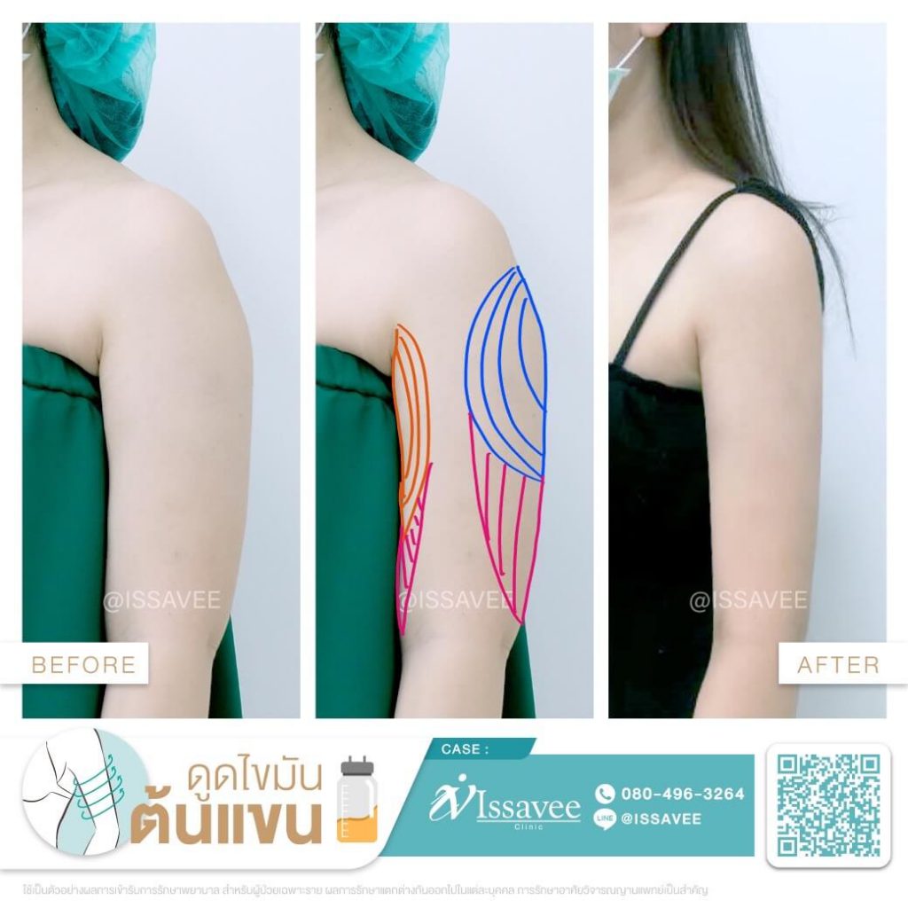 Issavee Clinic บริการดูดไขมันเฉพาะส่วน ปรับทุกสัดส่วนของร่างกายดูกระชับทุกจุด - 2