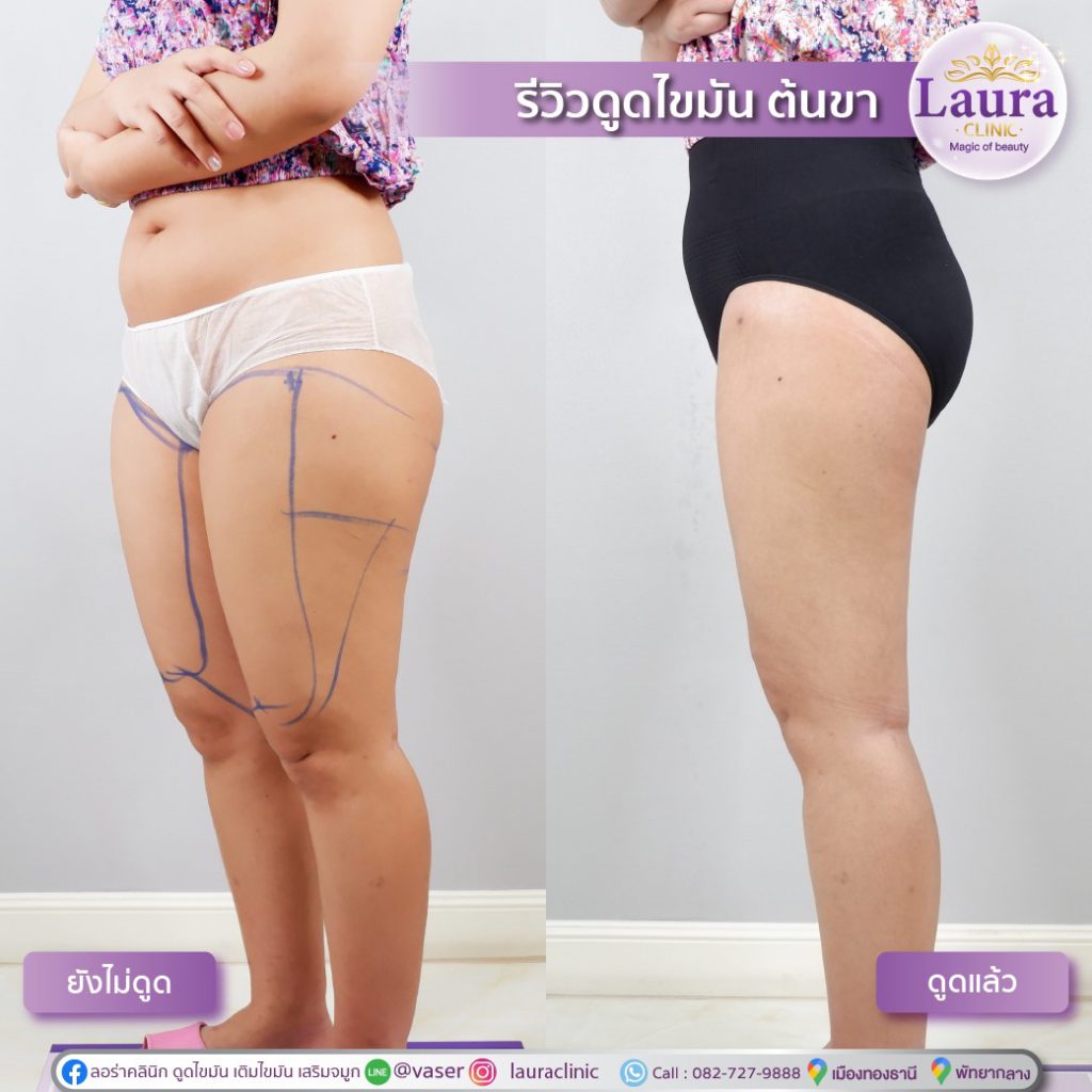 Laura Clinic คลินิกดูดไขมันต้นขา กระชับสัดส่วนต้นขา ผิวไร้ริวรอยหลังทำ - 2