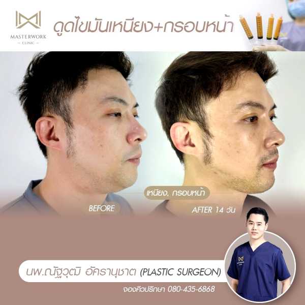 MasterWork Clinic บริการดูดไขมันเหนียง สร้างความชัดเจนให้ใบหน้าเด่นชัดมากขึ้น - 2