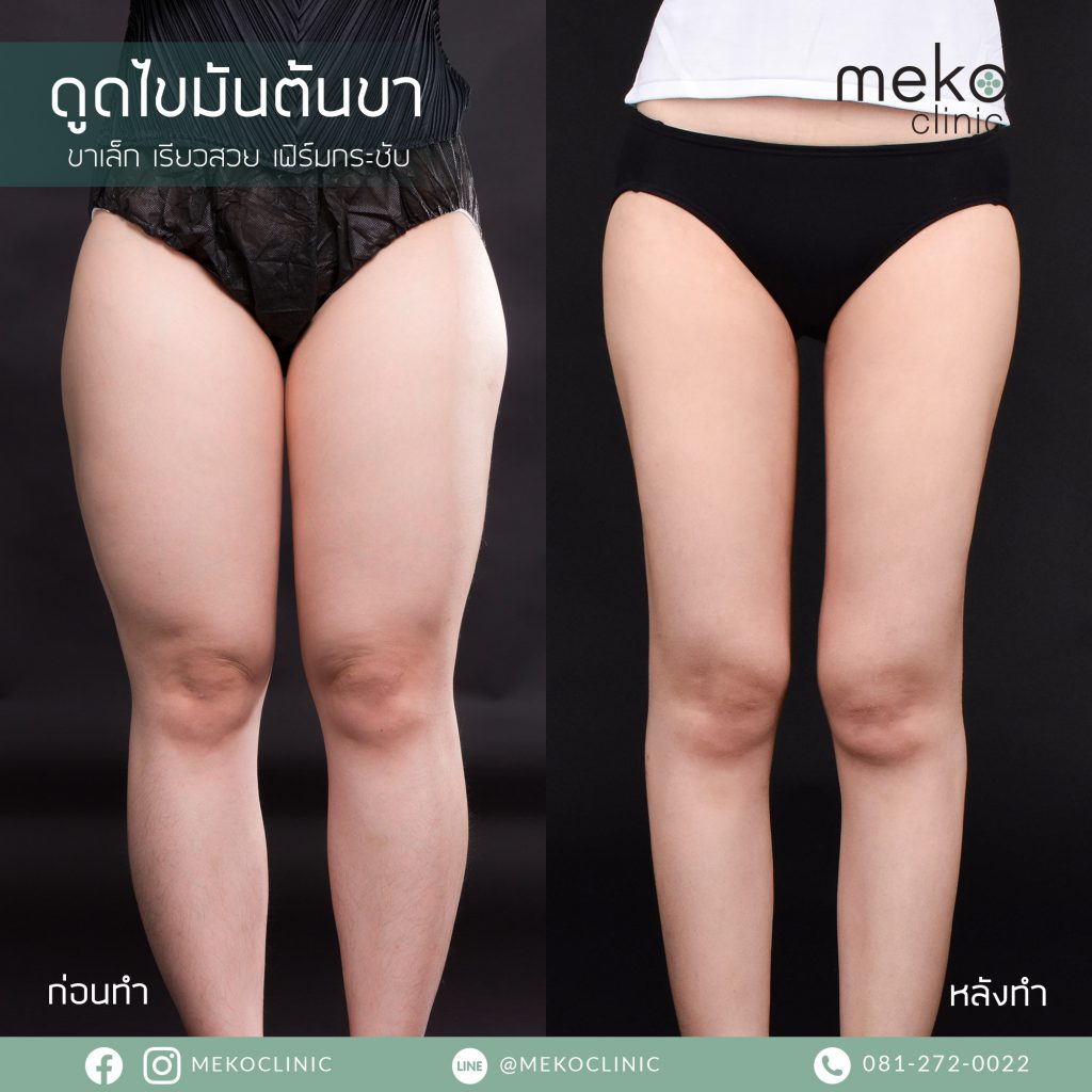 Meko Clinic คลินิกดูดไขมันต้นขา เปลี่ยนไซส์ขา XL เป็น ไซส์ X - 2