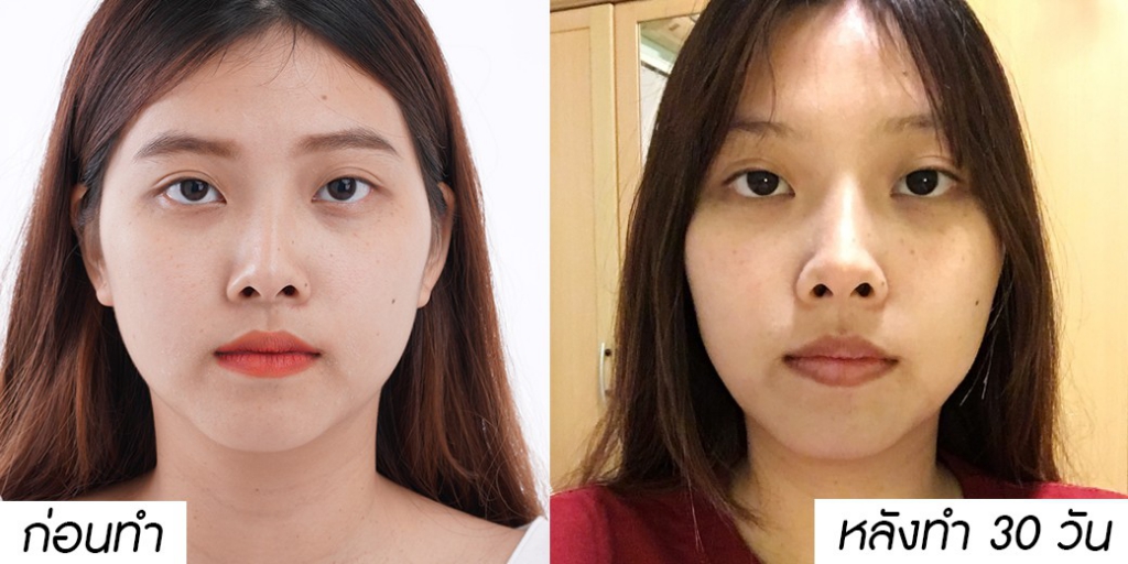 Meko Clinic คลินิกดูดไขมันหน้า กรอบหน้าชัด หมดปัญหาของใบหน้าที่ดูบานเกินไป - 2