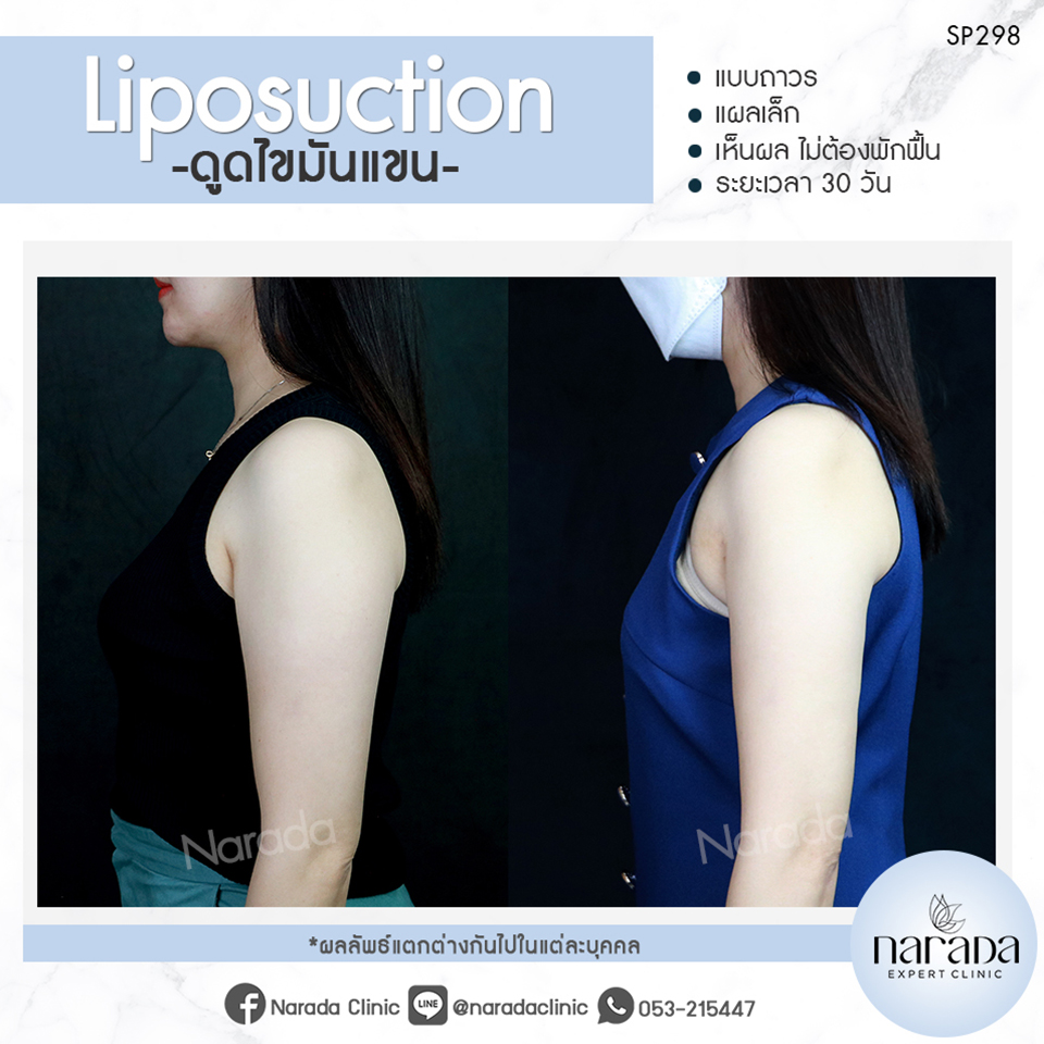 Narada Clinic คลินิกดูดไขมันต้นแขน ปรับแขนใหญ่ให้เล็กเรียวสวย เห็นผลหลังทำ - 2