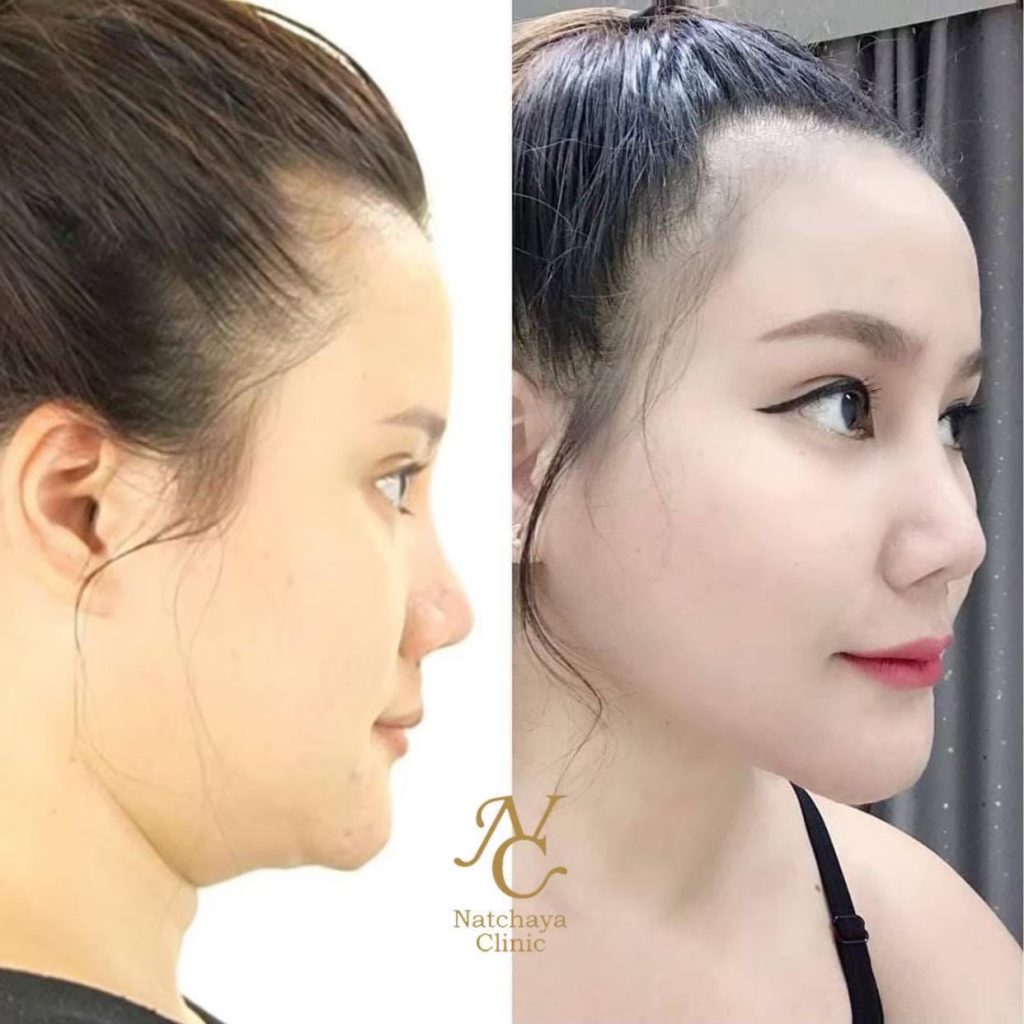 Natchaya Clinic ดูดไขมันเหนียง เปลี่ยนรูปหน้ากลมเป็นหน้าเรียววิธีการไม่ยาก - 2