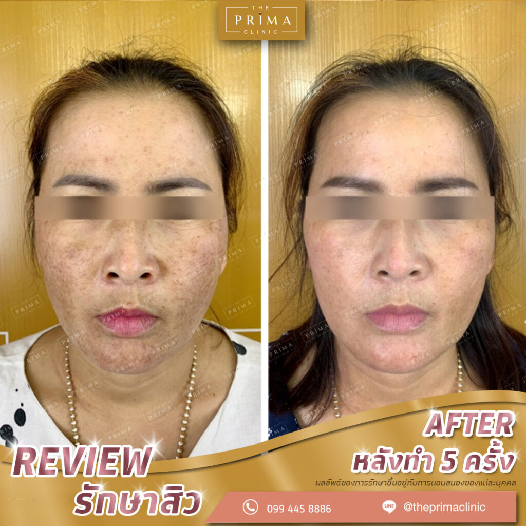 Prima Clinic บริการฉีดสิว ผิวหน้าเนียนใส ไร้สิว ลบริ้วรอยที่จากสิวที่เป็น - 2