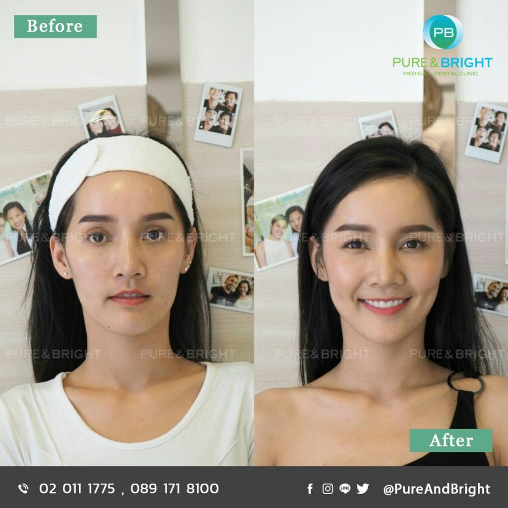 Pure and Bright Clinic บริการฉีดไขมันหน้า เลือกไขมันตัวเอง คัดกรองไขมันบริสุทธิ์มาใช้ - 2