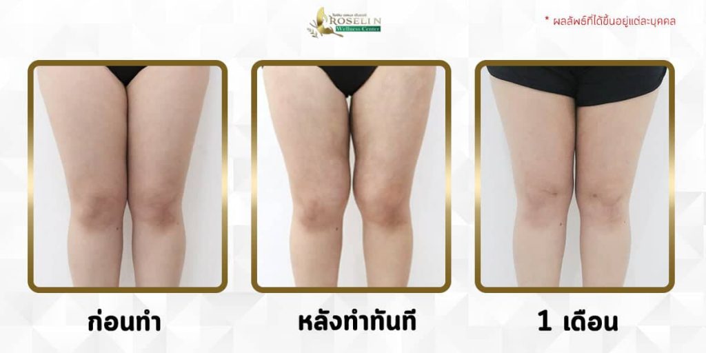 RWC Clinic คลินิกดูดไขมันต้นขา เสริมความมั่นใจในการแต่งตัวกลับมาอีกครั้ง - 2