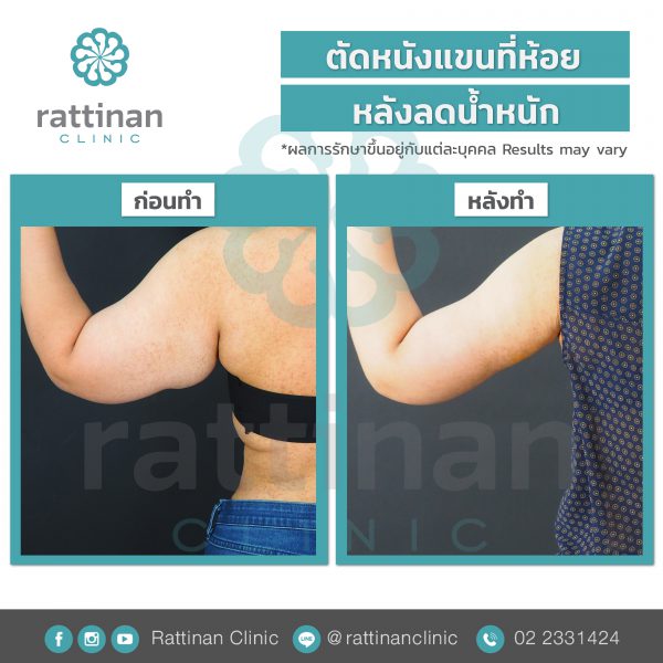 Rattinan Clinic ดูดไขมันต้นแขน ปรับสภาพผิว สร้างความเต่งตึง ยกกระชับ - 2