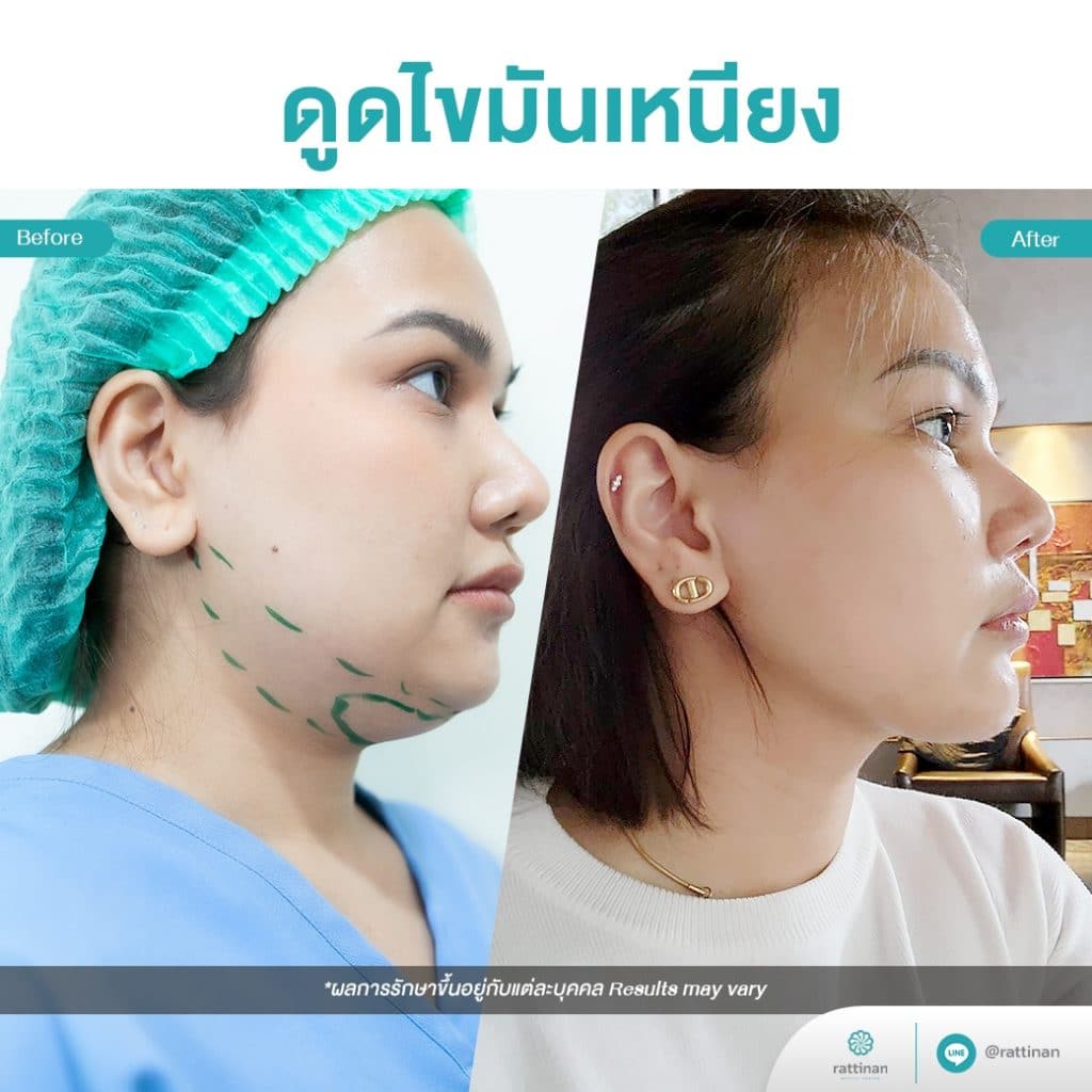 Rattinan Clinic บริการดูดไขมันเหนียง แก้ปัญหาคางสองชั้น ทำกรอบหน้าเรียวสวยได้รูป - 2