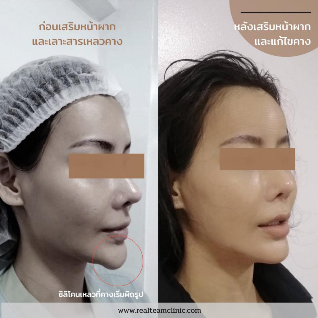 Real Time Clinic บริการเสริมหน้าผาก ศัลยกรรมจากทีมแพทย์ผู้เชี่ยวชาญ - 2