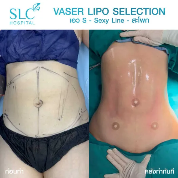 SLC Hospital โรงพยาบาลดูดไขมันหน้าท้อง เทคนิคการใช้ Vaser Lipo Selection - 2