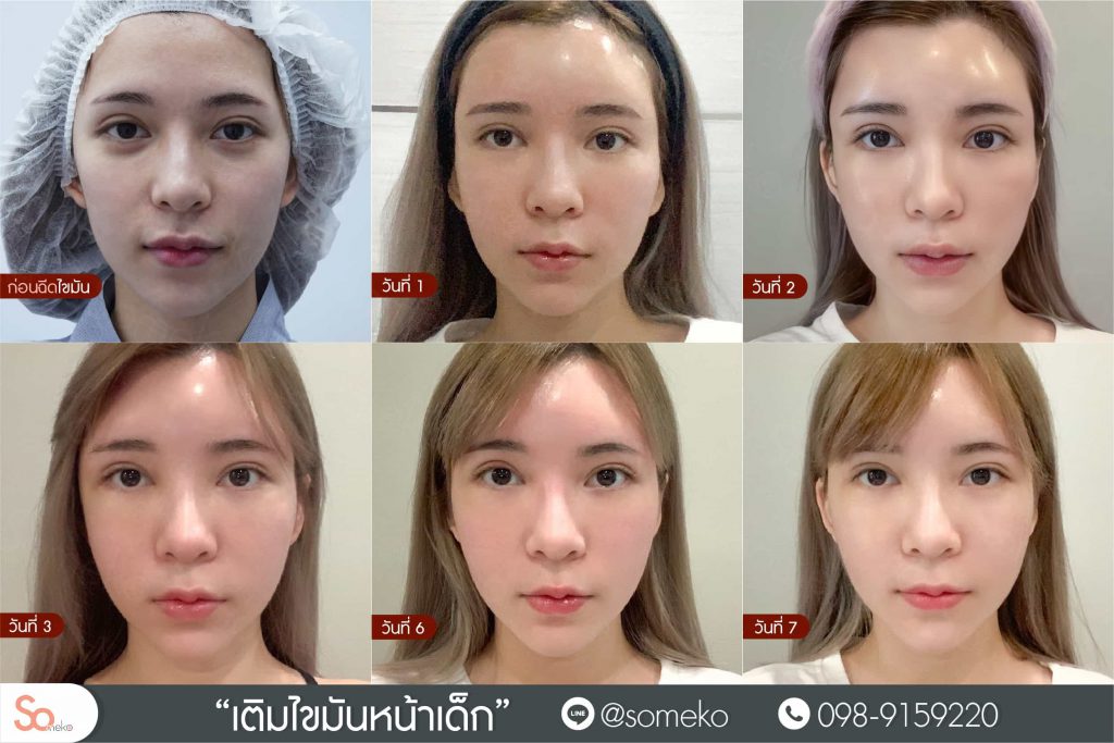 Someko Clinic ฉีดไขมันหน้า เสริมกระชับใบหน้าทุกจุดหลังการฉีด - 2