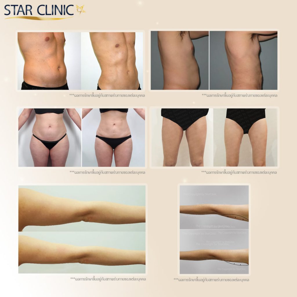 Star Clinic ดูดไขมัน หุ่นผอม สร้างประสบการณ์หุ่นผอมเพรียว ผิวสวยโดดเด่นหลังทำ - 2