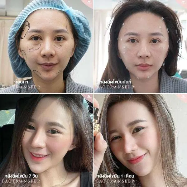 Theerathorn Clinic ฉีดไขมันหน้า สร้างความอ่อนวัยให้ผิวหน้าด้วยไขมันตัวเอง - 2