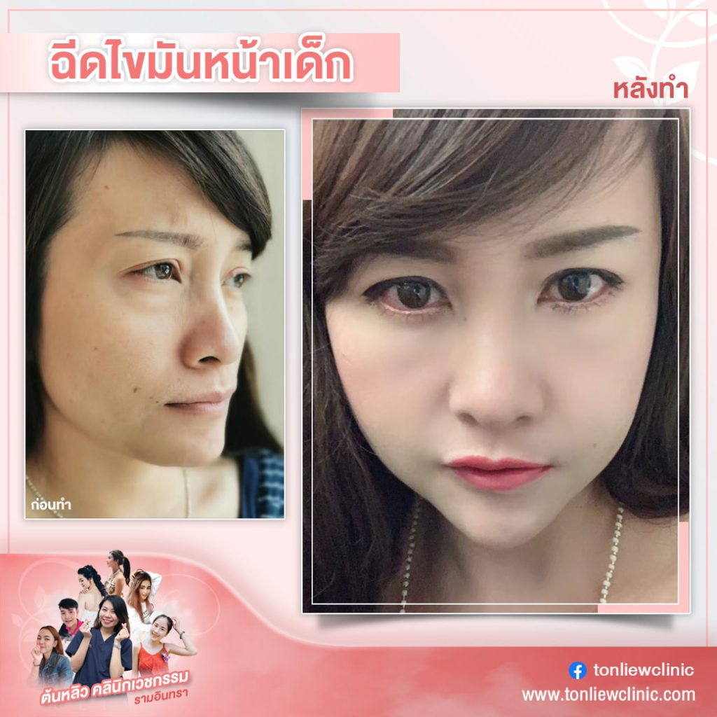 Tonliew Clinic คลินิกฉีดไขมันหน้า หน้าเรียวสวย หายเร็ว ไม่ต้องเสียเวลาฟื้นตัวให้นาน - 2