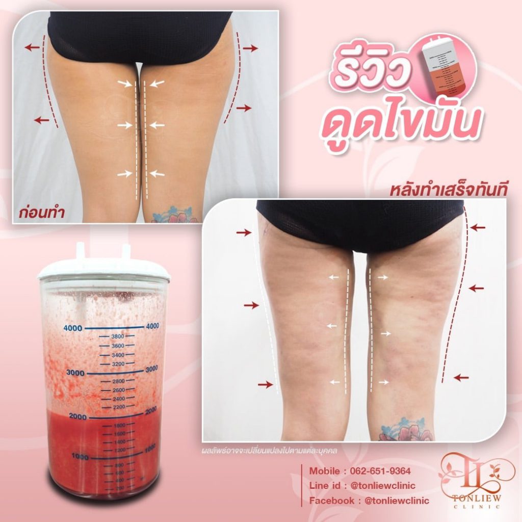 Tonliew Clinic บริการดูดไขมันต้นขา ปรึกษาทุกปัญหาของรูปร่างได้อย่างไม่ต้องกังวล - 2