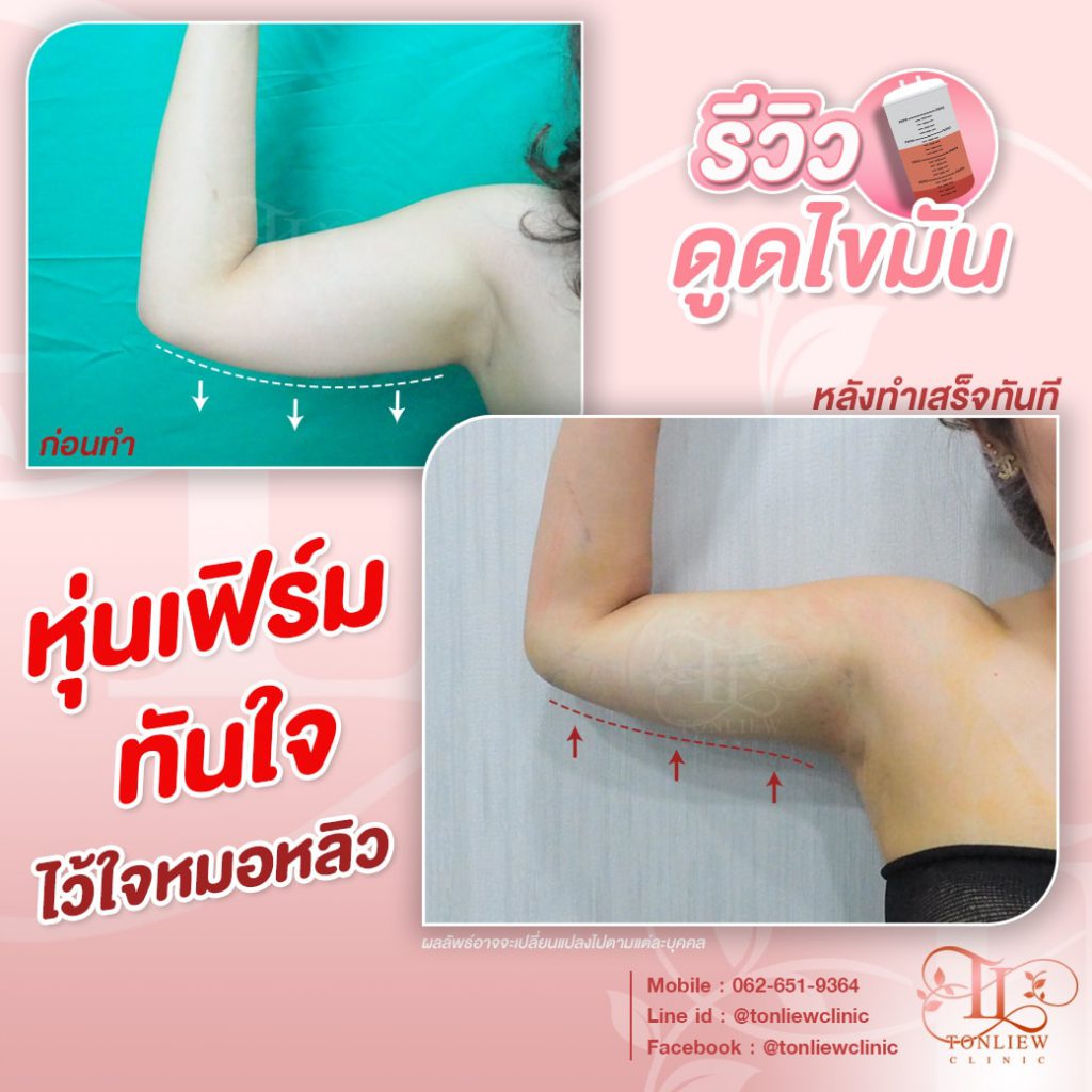 Tonliew Clinic บริการดูดไขมันต้นแขน ขจัดไขมัน ฟื้นฟูสภาพผิวรอบวงแขน - 2