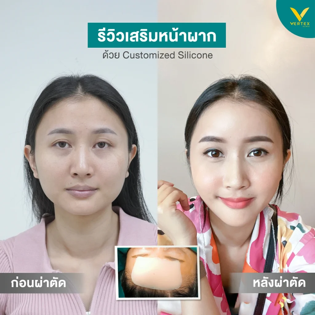 Vertex Clinic เสริมหน้าผาก ซิลิโคน 3 มิติ โดดเด่นทุกมิติของใบหน้า - 2