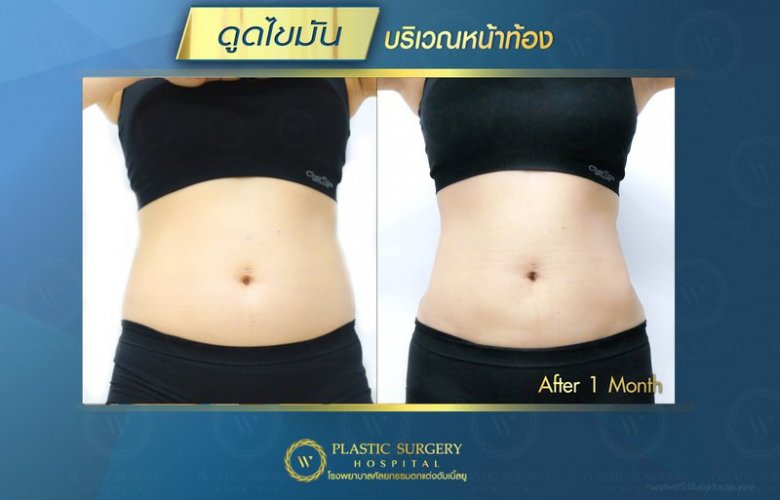 W Plastic Surgery Hospital บริการดูดไขมัน หุ่นผอม พร้อมยกกระชับผิวในคอร์สเดียว - 2