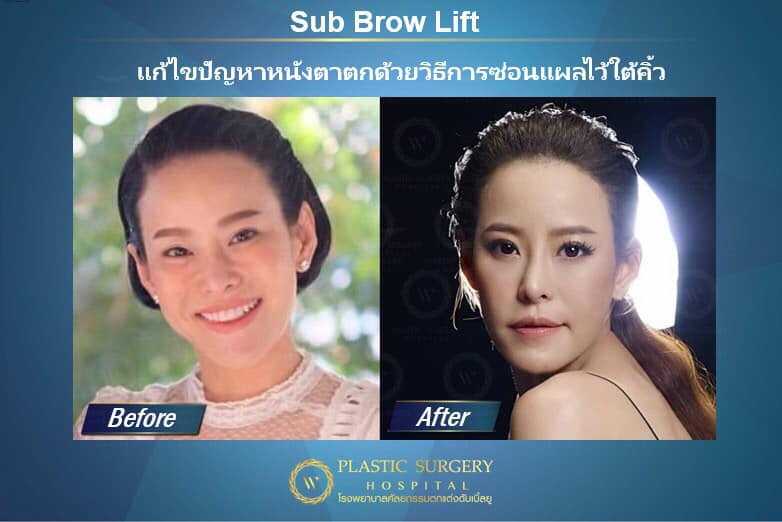 W Plastic Surgery Hospital ยกคิ้วซ่อนรอยแผล เทคนิคเฉพาะ Sub Brow Lift - 2