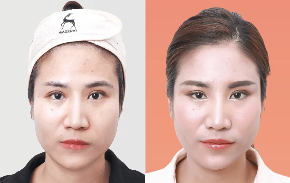 Waleerat Clinic คลินิกยกคิ้ว แก้ปัญหาของรอยแผลด้วยเทคนิค Sub Brow Lift - 2