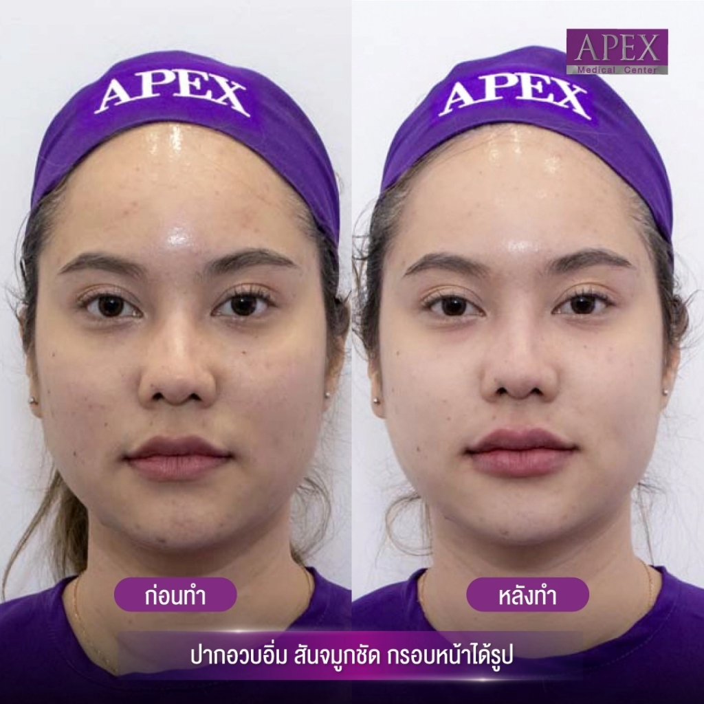 Apex Medical Clinic ฉีดฟิลเลอร์ พัทยา ให้บริการโดยหมอผู้เชี่ยวชาญเฉพาะทาง - 2