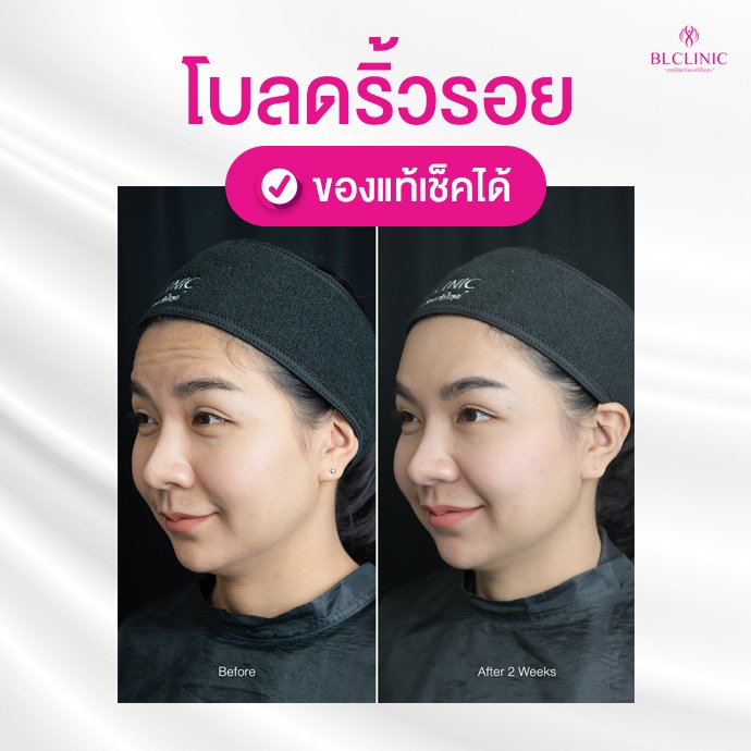 BL Clinic คลินิกโบท็อก นครราชสีมา กระตุ้นผิวหน้า สร้างความกระชับ ปลอดภัยทุกขั้นตอน - 2