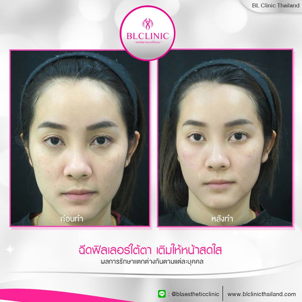 BL Clinic บริการฉีดฟิลเลอร์ นครราชสีมา เสริมความปังให้ผิวหน้า มีความโดดเด่นเห็นได้ชัด - 2