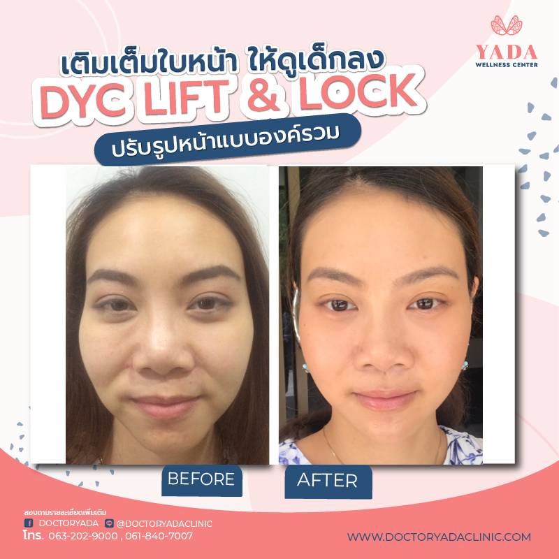 Doctor Yada Clinic คลินิกฉีดฟิลเลอร์ พัทยา ฉีดกระชับผิวหน้า สร้างความเต่งตึงให้ผิว - 2