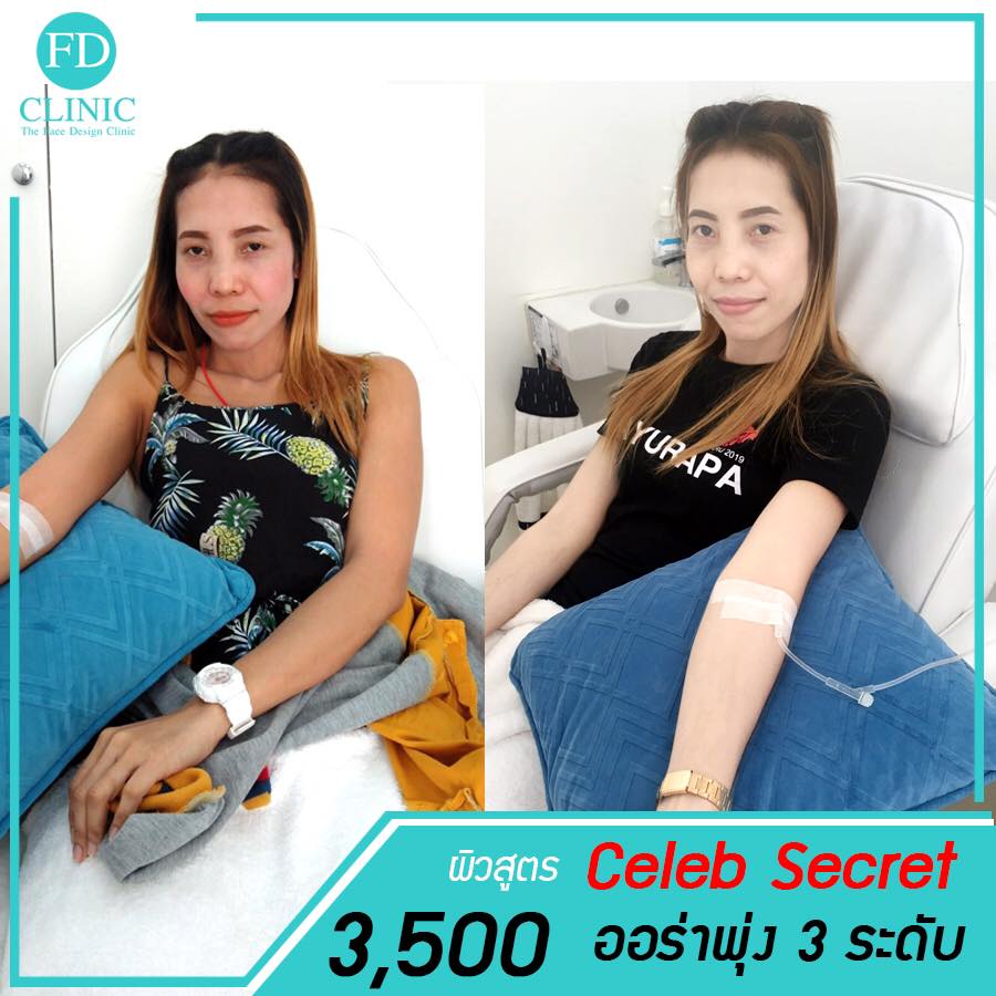 FD Clinic บริการฉีดผิวขาว ขอนแก่น ปรับสภาพผิวและรูปหน้า คลินิกอันดับแรก ๆ ที่คนต้องนึกถึง - 2