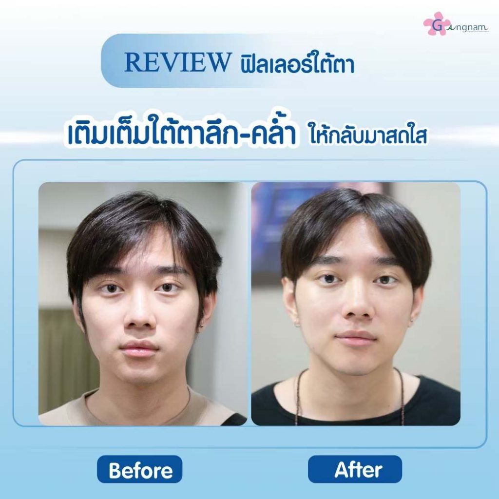 Gangnam Clinic คลินิกฉีดฟิลเลอร์ นครราชสีมา เติมทุกร่องลึก ปรับรูปหน้าให้เด่นชัด - 2