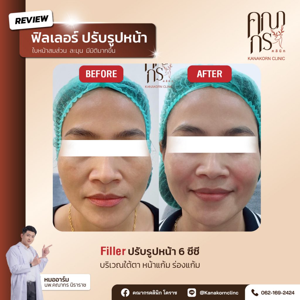 Kanakorn Clinic คลินิกฉีดฟิลเลอร์ นครราชสีมา ยกกระชับผิว ผิวดูเปล่งปลั่งขึ้นกว่าเดิม - 2