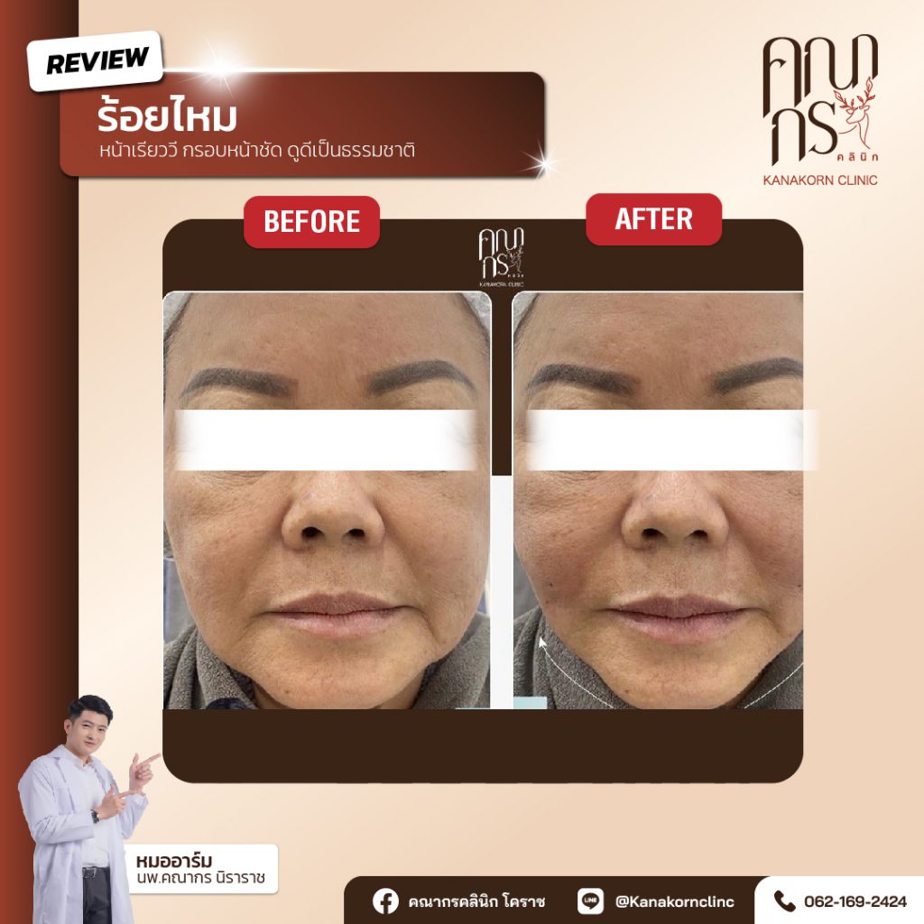 Kanakorn Clinic บริการร้อยไหม นครราชสีมา ปรับสมดุลใบหน้า ปรับระดับผิวให้เด่นชัด - 2