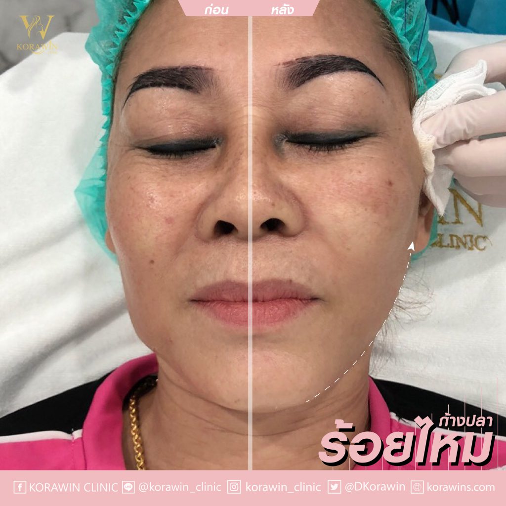 Korawins Clinic บริการร้อยไหม นครราชสีมา ยกกระชับใบหน้า เส้นไหมคุณภาพดี - 2