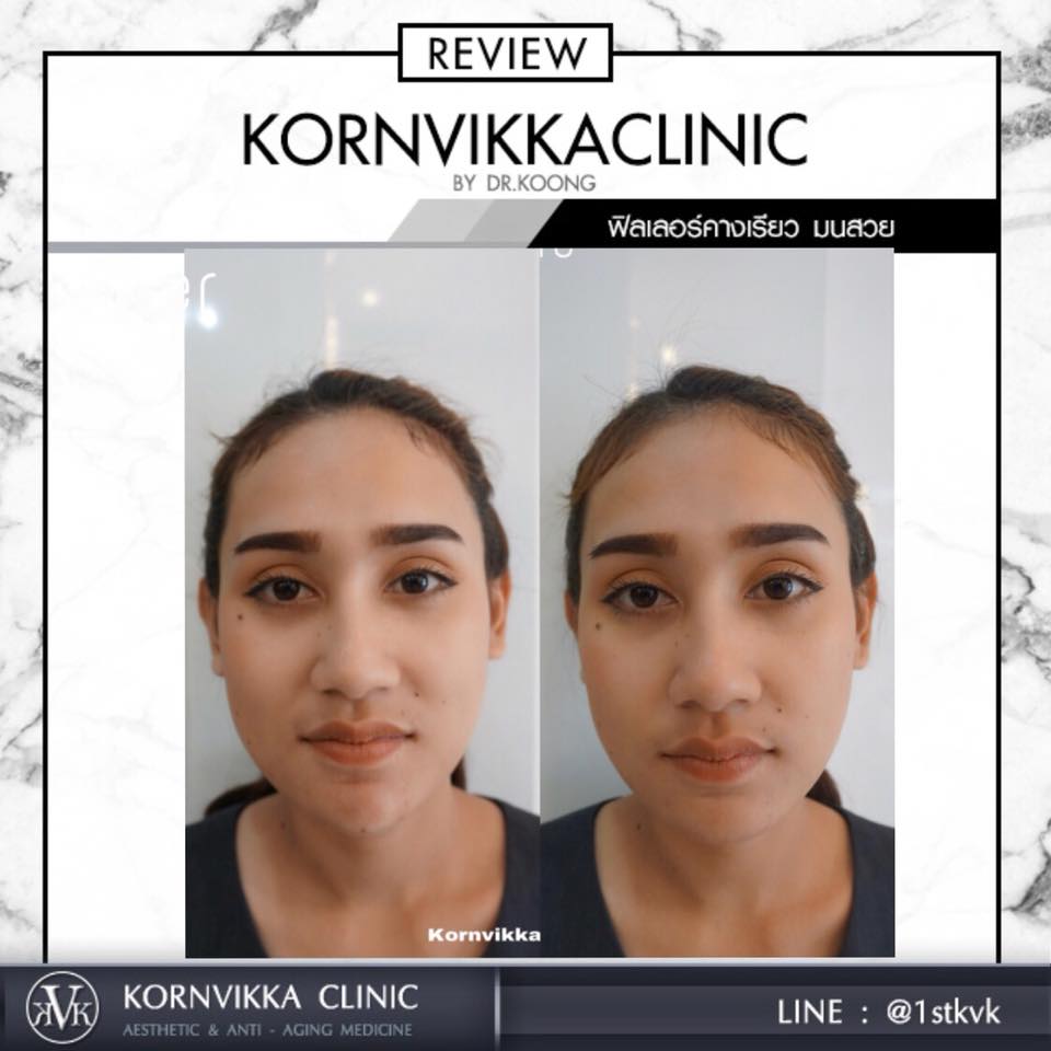 Kornvikka Clinic ฉีดฟิลเลอร์ นครราชสีมา ผิวสวยใส ผิวดูนุ่ม เต่งตึง เนียนดูเป็นธรรมชาติ - 2