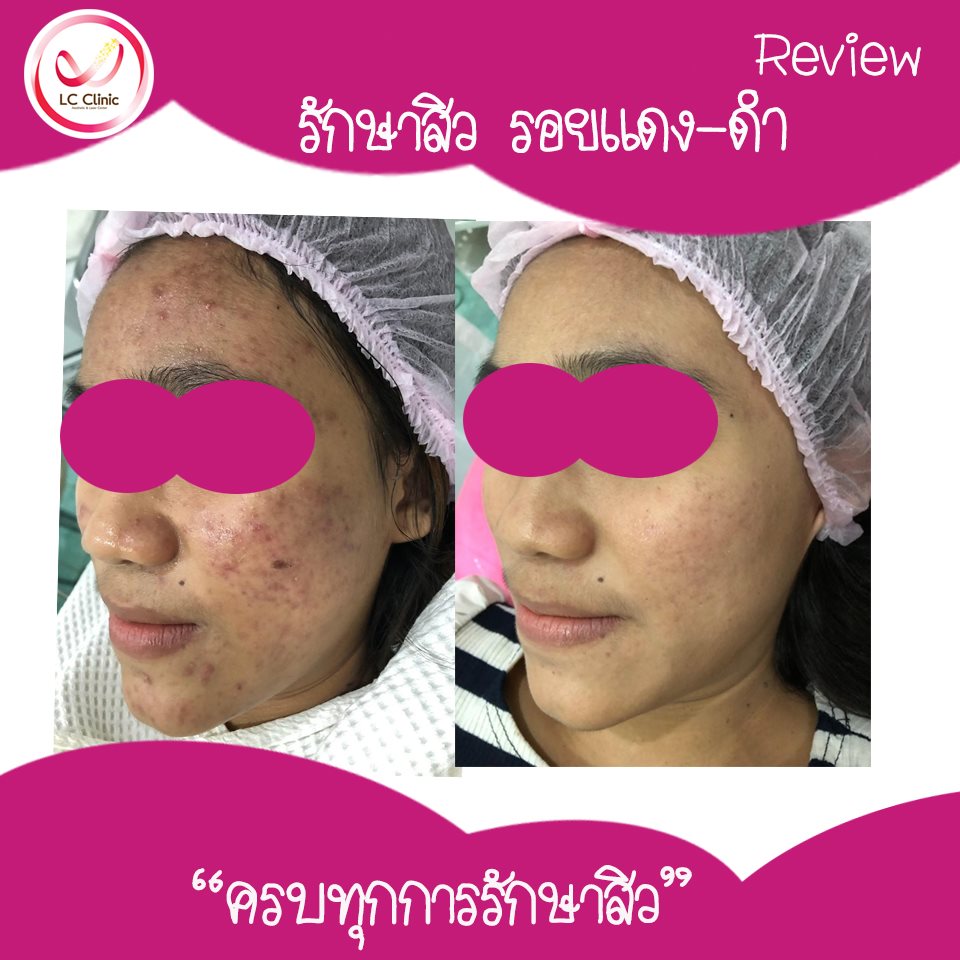 LC Clinic คลินิกรักษาสิว ฝ้า กระ นครราชสีมา เคลียร์ผิวที่น่ากังวล - 2