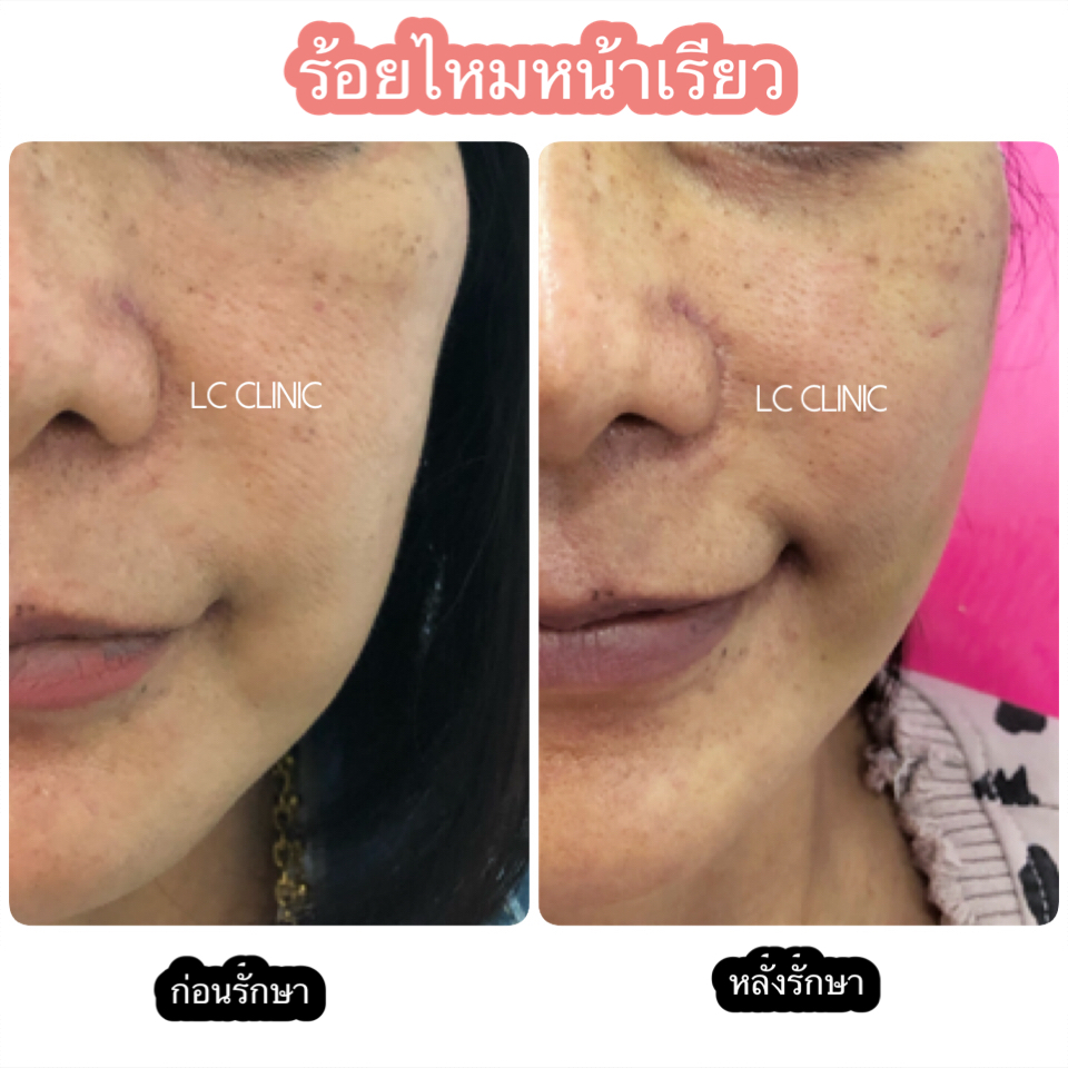 LC Clinic คลินิกร้อยไหม นครราชสีมา เจ็บน้อย อยู่ได้นาน ไม่ต้องกลัวบวมนาน - 2