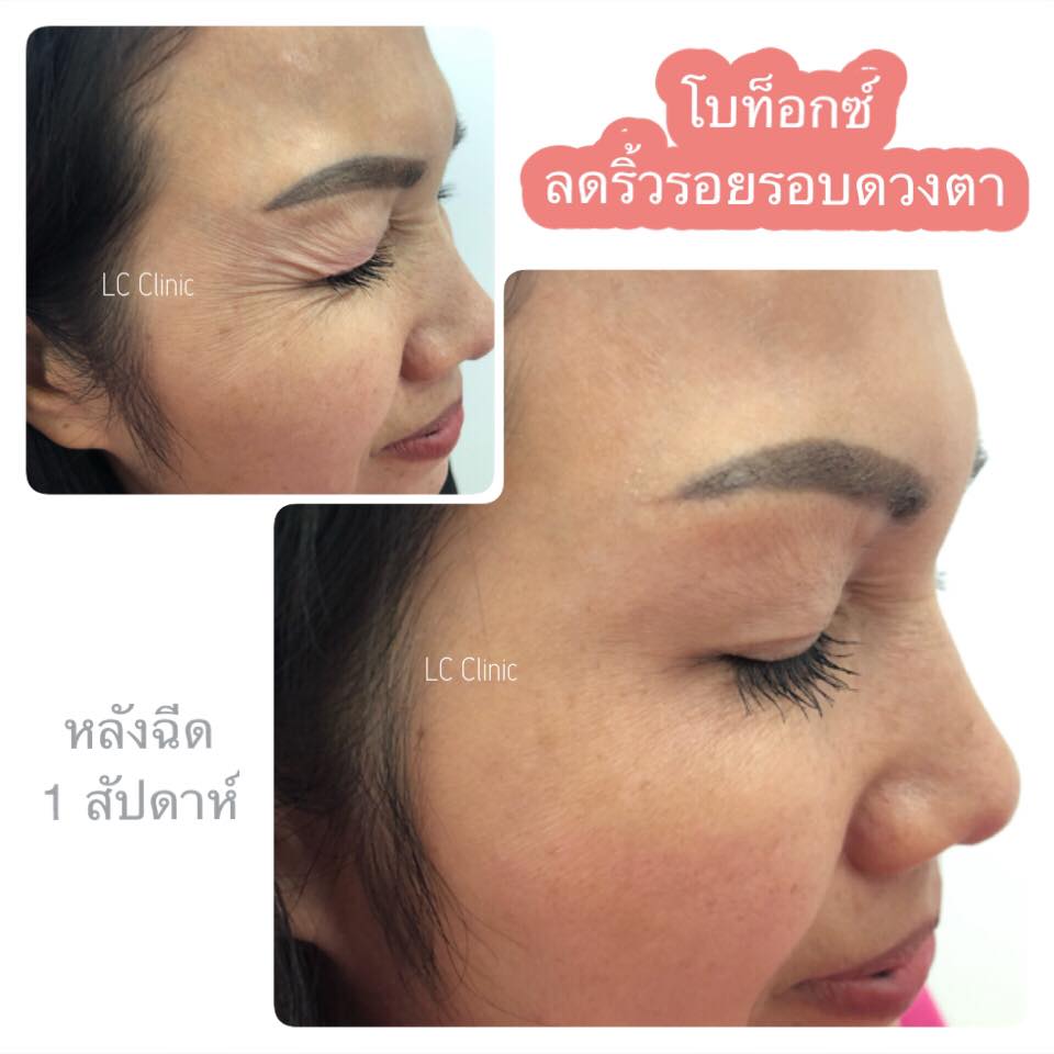 LC Clinic ฉีดโบท็อก นครราชสีมา ยกกระชับผิว ยกระดับผิวพรรณขาวใส ไร้สิว - 2