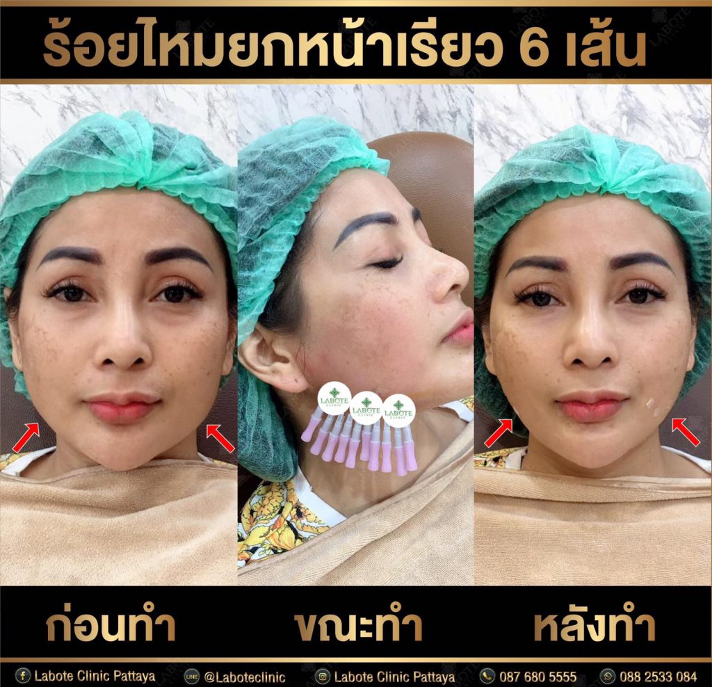 Labote Clinic บริการร้อยไหม พัทยา กระตุ้นการทำงานของคอลลาเจน เส้นไหมคุณภาพดี - 2