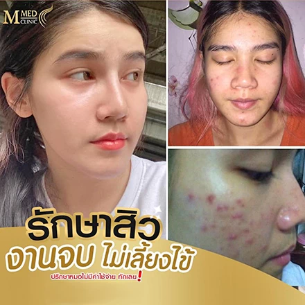 M med Clinic บริการรักษาสิว ฝ้า กระ ขอนแก่น เริ่มต้นการปรับรูปแบบของผิวได้อย่างมืออาชีพ - 2