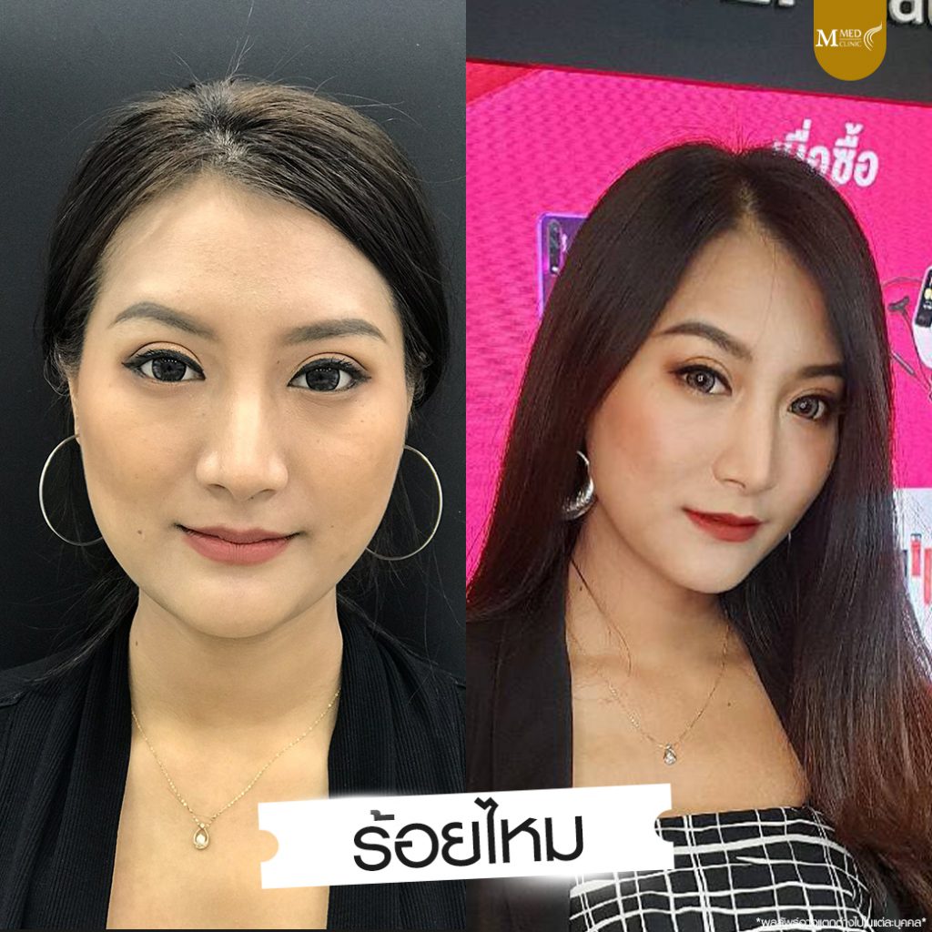 M med Clinic บริการร้อยไหม พัทยา เสริมความสวยให้ใบหน้าได้อย่างปลอดภัยทุกขั้นตอน - 2