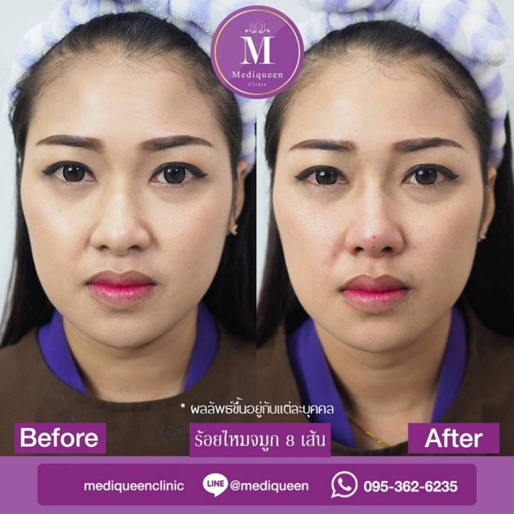 Mediqueen Clinic ร้อยไหม พัทยา คืนความอ่อนวัยให้ผิวหน้า ดูยกกระชับ เต่งตึงมากขึ้น - 2