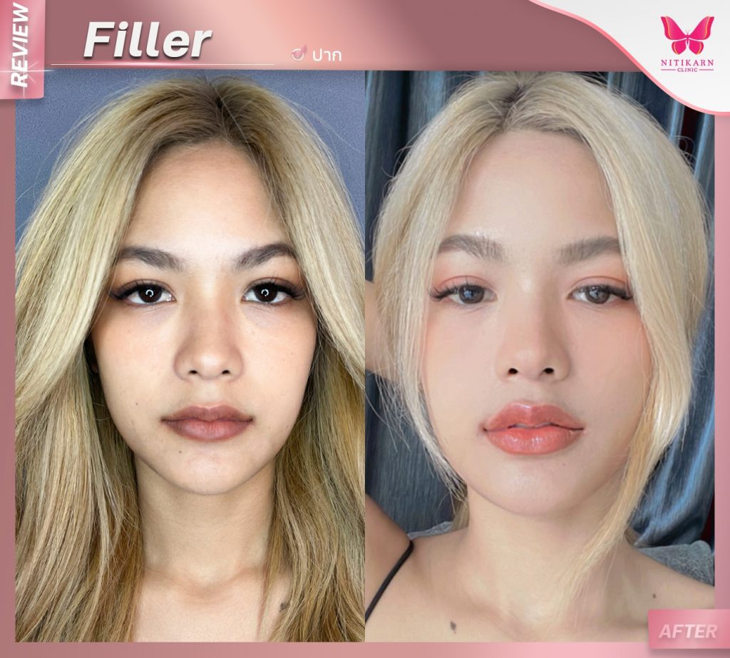 Nitikarn Clinic บริการฉีดฟิลเลอร์ นครราชสีมา ฉีดฟิลเลอร์โดยแพทย์ผู้เชี่ยวชาญ - 2