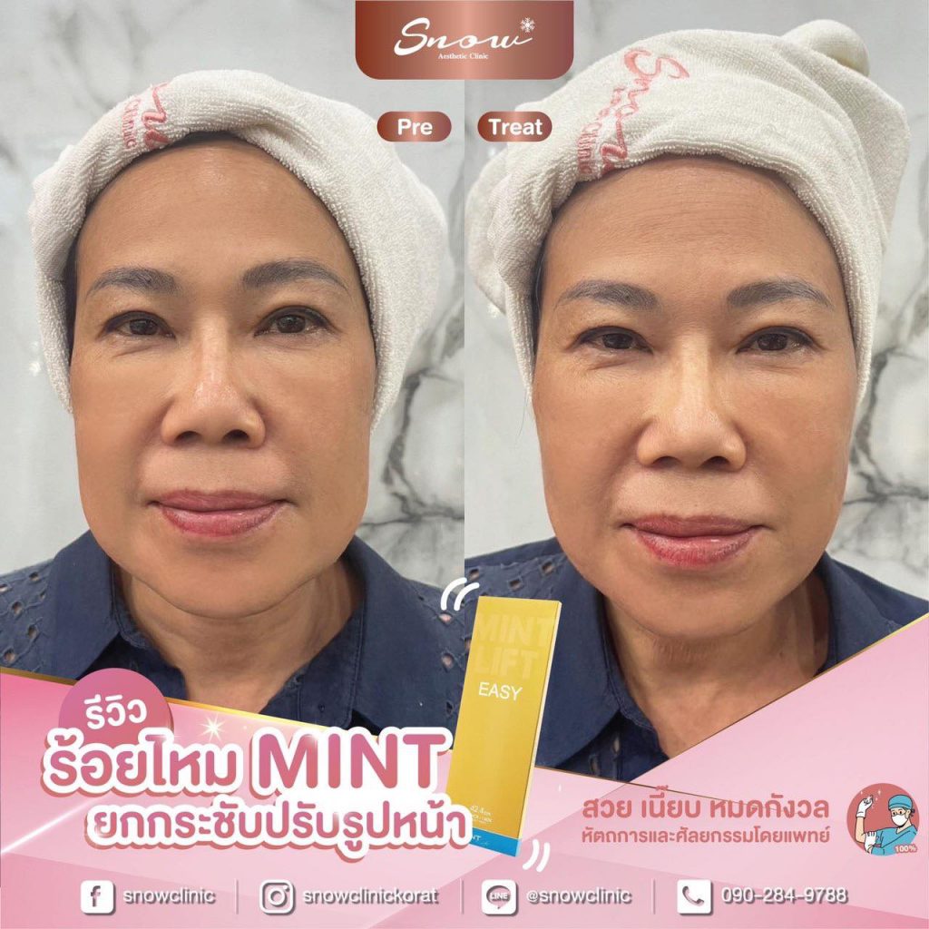 Snow Clinic คลินิกร้อยไหม นครราชสีมา ปรับหน้าเรียว ปรับอายุใบหน้าอ่อนลงอีกครั้ง - 2