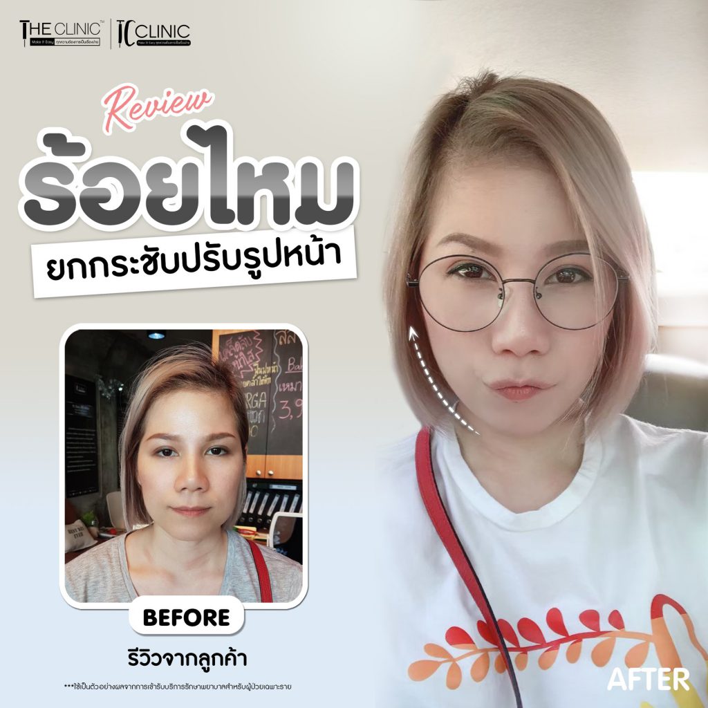 TC Clinic ร้อยไหม นครราชสีมา เทคนิคเสริมร้อยไหม ฉีดโบท็อก ยกกระชับหน้า ยกกระชับผิว - 2