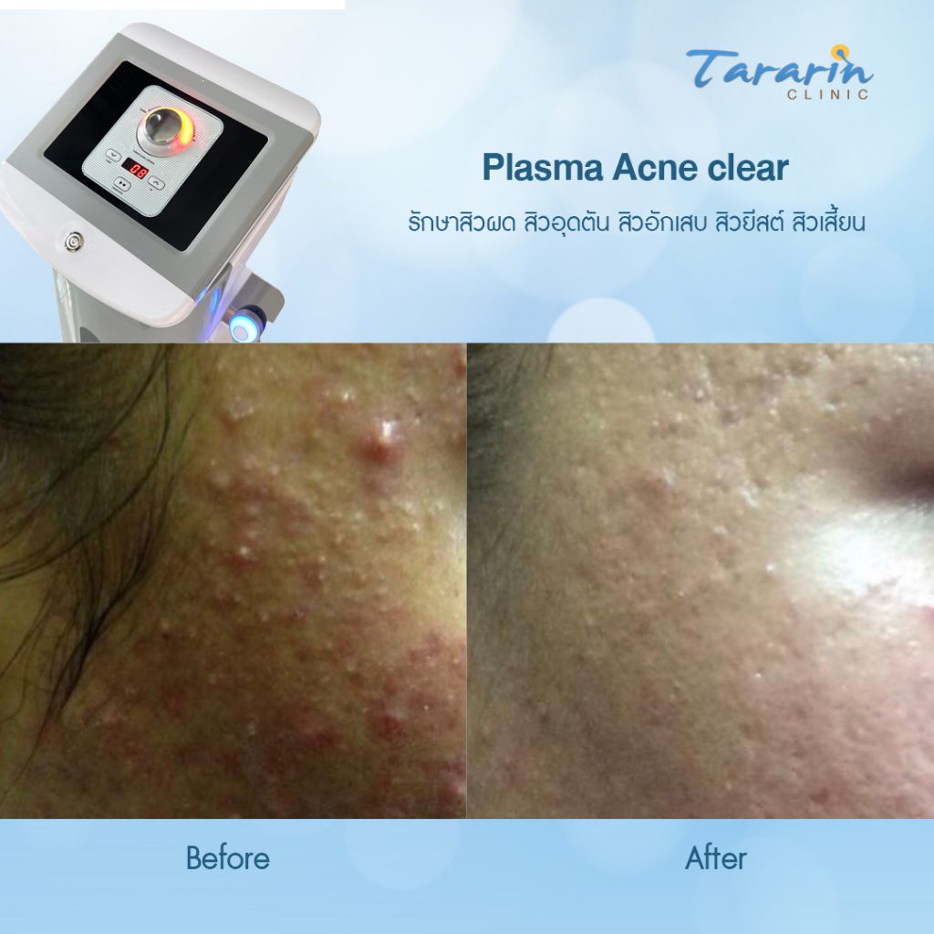 Tararin Clinic คลินิกรักษาสิว ฝ้า กระ ขอนแก่น ทุกปัญหาของผิวทั้งใบหน้าและร่างกายรักษาได้ - 2