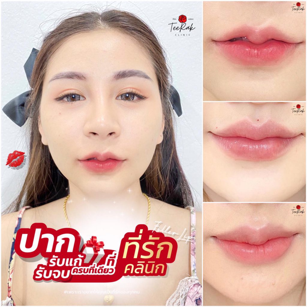 TeeRak Clinic คลินิกฉีดฟิลเลอร์ ขอนแก่น ปรับเปลี่ยนโหงวเฮ้งของใบหน้าให้เห็นชัดมากขึ้น - 2